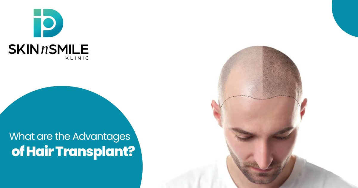 Advantages of Hair Transplant Advantages of Hair Transplant