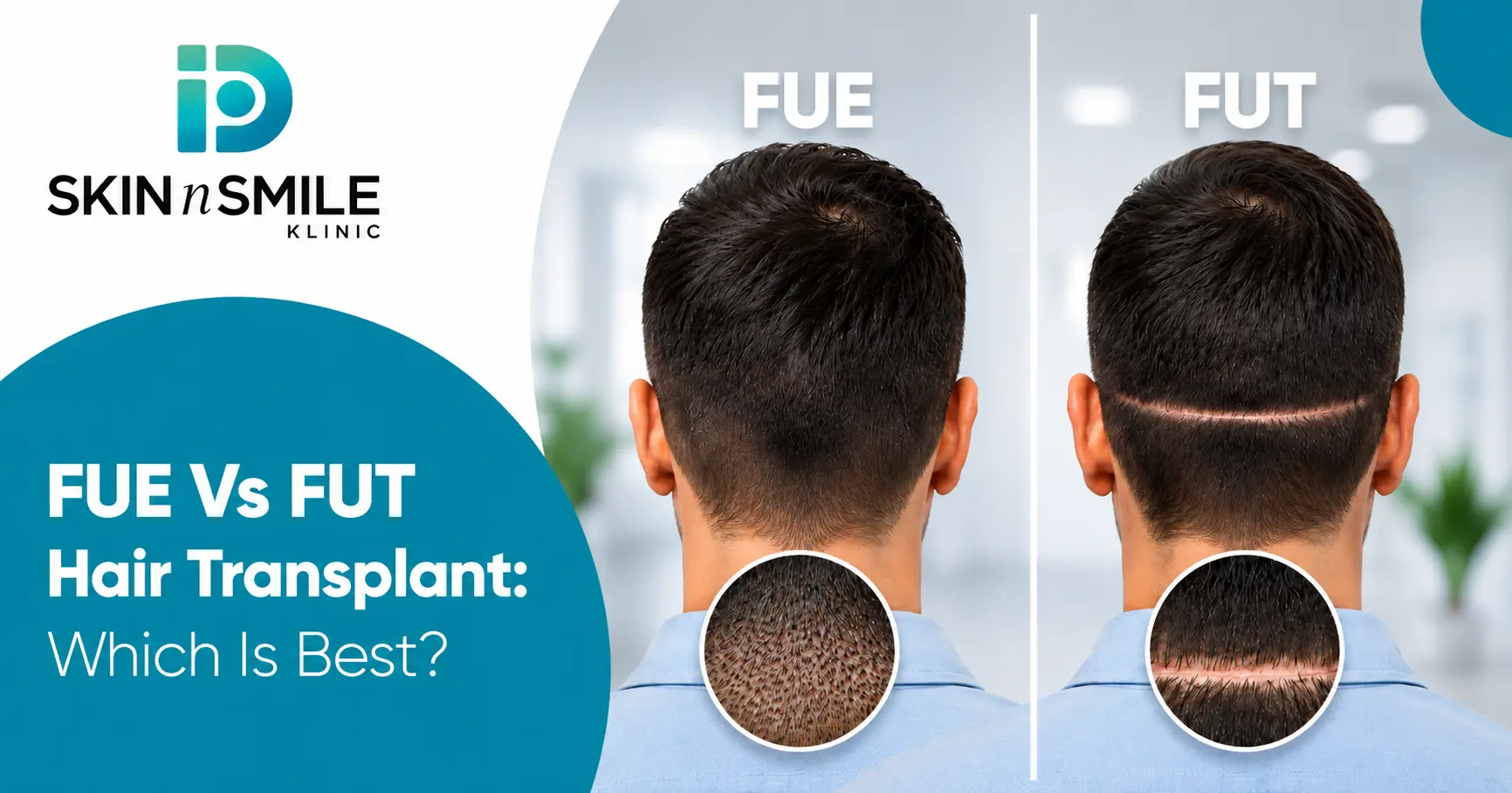 FUE vs FUT hair transplant