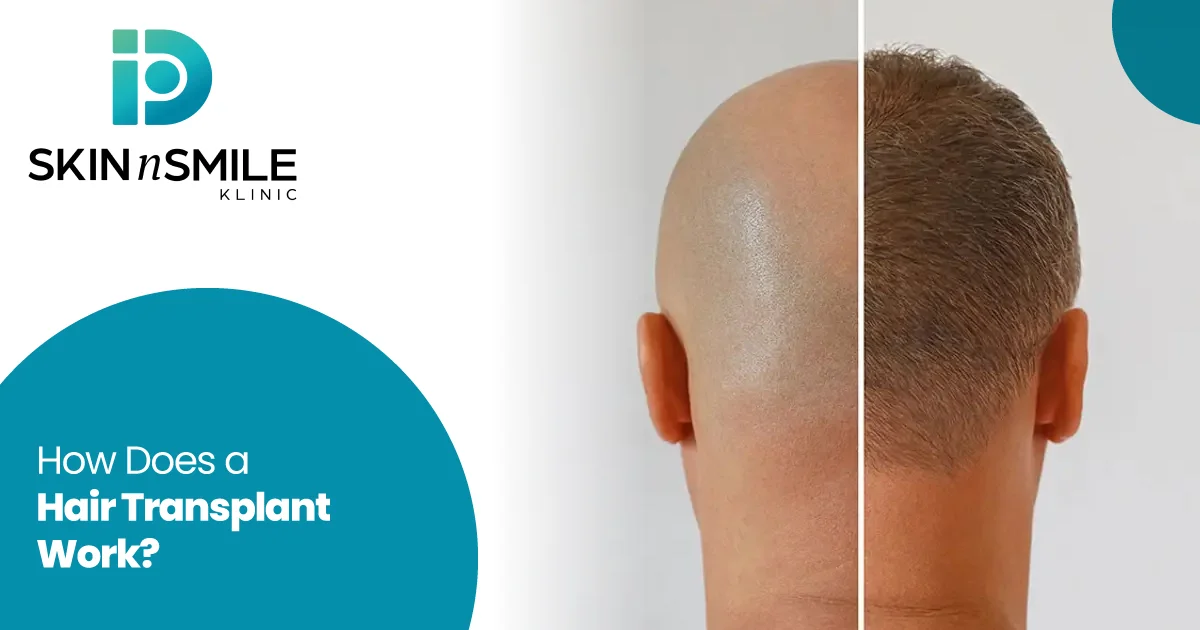 Hair Transplant Work