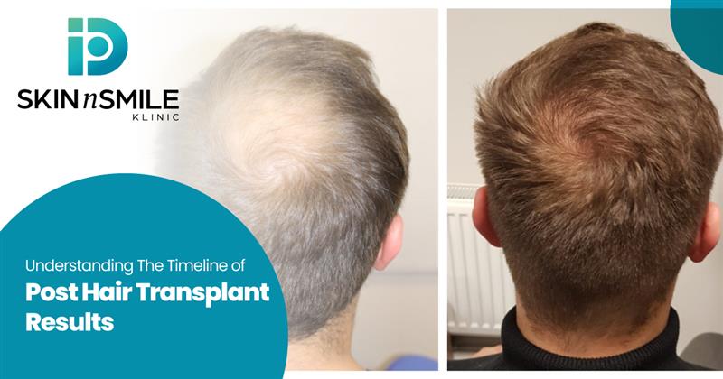 Hair Transplant Results Hair Transplant Results