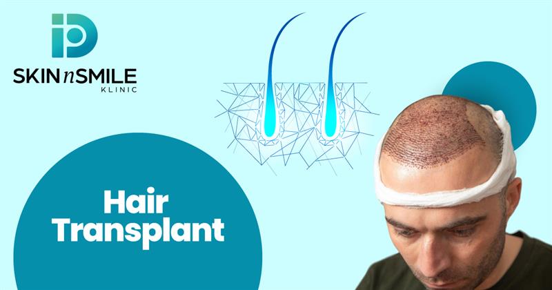 Best Hair Transplant Treatment Clinic in Ahmedabad